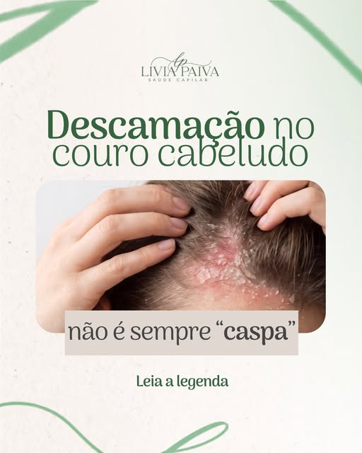 Ver pequenas escamas no couro cabeludo não significa automaticamente que o problema é “caspa”. Desca