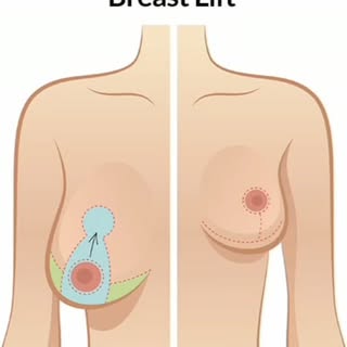 Post-baby / post-weight loss body change no one warns you about...
#breastlift #mommymakeover #bodyc