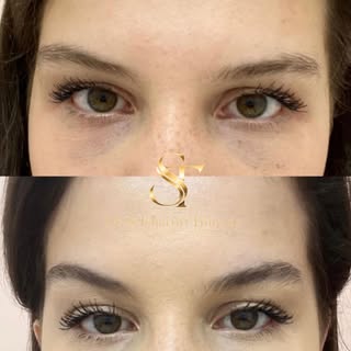 Bambi Eyes Botoksu ✨

Daha keskin bakışlar ✅
Daha kalkık kaşlar ✅