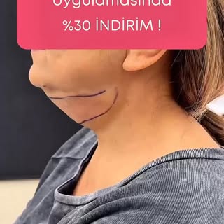 Selahattin Tulunay ile gıdı liposuction işlemlerinde %30 indirim fırsatı başladı.

Gıdı bölgesindeki