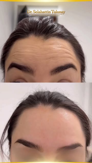 Botox uygulaması; mimik hareketlerine bağlı oluşan çizgi ve kırışıklıkların görünümünü azaltmaya, da