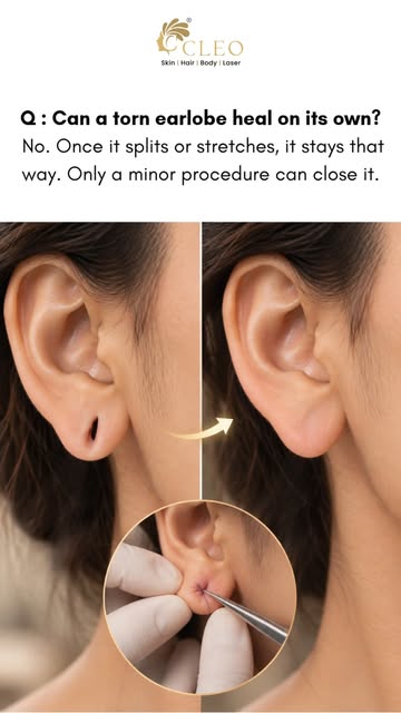 Stopped wearing your favourite jhumkas because of a torn earlobe? 👂✨

Heavy earrings. An accidental