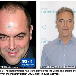 Great results stand the test of time.

We were delighted to see HRBR patient James Nesbitt featured 