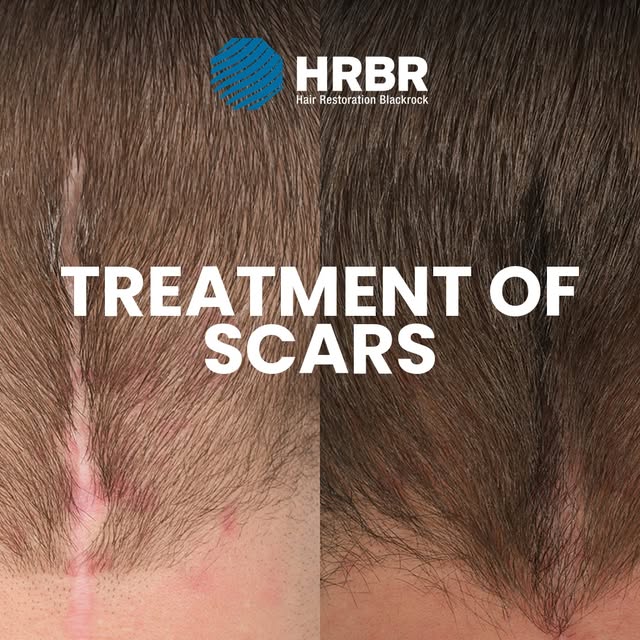Treatment of scars: a patient story from HRBR.

Following brain surgery, this patient was left with 
