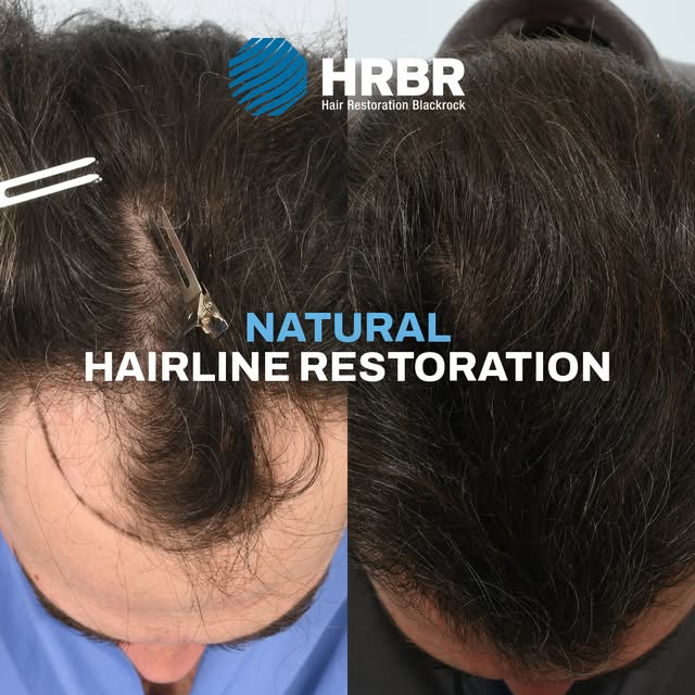 A natural-looking hairline is the foundation of a successful hair transplant.

This patient received