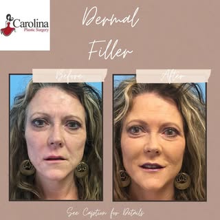 Ozempic Face? Here's How Filler Can Help You Look Like You Again 💉
Rapid weight loss can lead to a