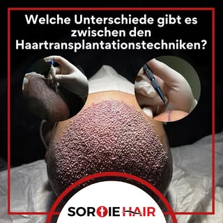 ❓Welche Unterschiede gibt es zwischen den Haartransplantationstechniken?
📌 Bei der Haartransplantat