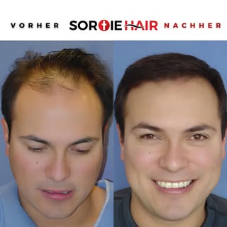 Die Veränderung beginnt im Kopf. Wir bringen Ihre in 30 Jahren verlorenen Haare an einem Tag zurück.