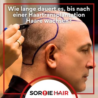 ❓Wie lange dauert es, bis nach einer Haartransplantation Haare wachsen?
📌 Sobald der Heilungsprozes
