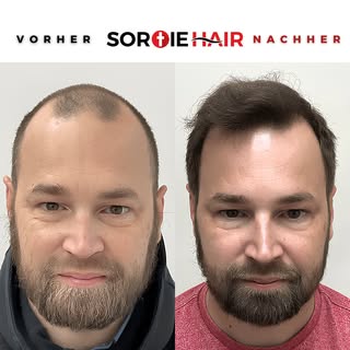 Mit unserem erfahrenen Team und dem Einsatz der fortschrittlichsten Technologie bei Haar-, Bart- und