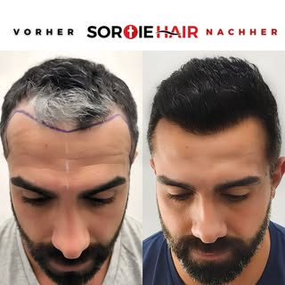 Mit einer Haartransplant gehört Kahlheit der Vergangenheit an. Wenn Sie Ihr altes dichtes Haar wiede