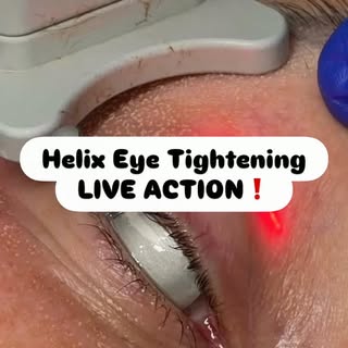 Watch Helix Eye Tightening in action 👀✨

This precise CO2 laser treatment targets the delicate skin