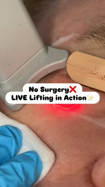 Live tightening with Helix CO2 around the eyes 👀✨

The Helix CO2 laser delivers precise fractional 