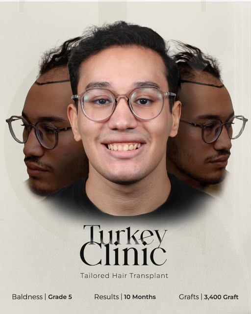 Grade 5 Hair Loss | 3,400 Grafts | 10-Month Results
10 months after the procedure, the new growth is
