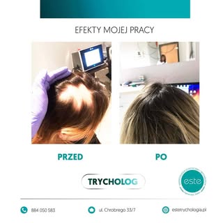 👨‍🦲 Znaczące #ubytki włosów? 
.
🔹 Zobacz, jak sobie z tym poradziłam w moim gabinecie. Po raz kol