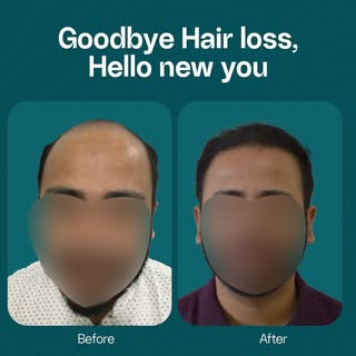 Goodbye Hair Loss, Hello New You.

Witness the incredible transformation of our patient. A successfu