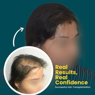 From Hair Loss to Hair Confidence!

Watch this incredible transformation unfold! Our expert hair res