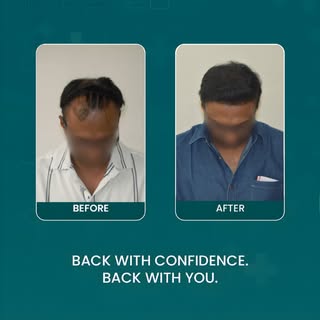 Rediscover the confidence that comes with a natural, fuller look.

Through advanced hair restoration