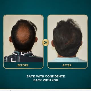 Before ➡ After 🔥

Say goodbye to hair loss and hello to confidence!

A successful hair transplant c