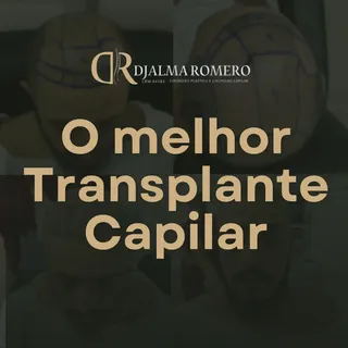 Conheça nossos diferenciais 👇👇👇

- Transplante Realizado com o Renomado Cirurgião Plástico Dr. Dj
