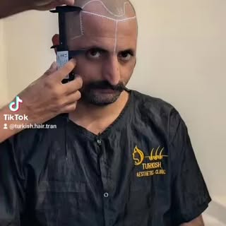 Introducing the FIRST Turkish Hair Transplant Clinic in Pakistan!
Say goodbye to hair loss and hello