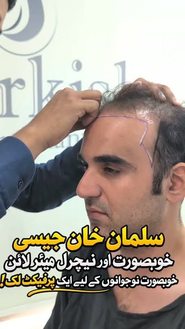 🔹 Personalized Hairline & Graft Planning
Customized hairline design and graft distribution accordin