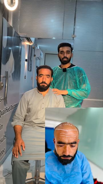 کمزور Donor سے بھی اچھا Hair Transplant Result ممکن ہے؟

جی ہاں، اگر proper planning، مناسب graft di