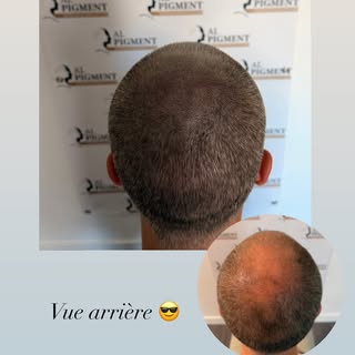 ✨ Vue arrière : chaque détail compte.

La tricopigmentation ne s’arrête pas à la ligne frontale. L’o