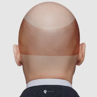 Haartransplantation bei FirstHair - Ihr Spenderbereich könnte Ihnen wieder volles Haar geben! 😁

#f