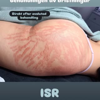 Nu är det hög tid att boka in din ISR behandling! Har du frågor? Boka en kostnadsfri konsultation (t