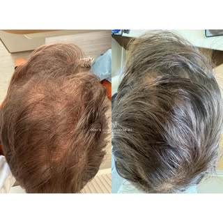 ANTES X DEPOIS 

Resultado que merece ser compartilhado ❤️

Caso de calvice (Alopecia Androgenética)