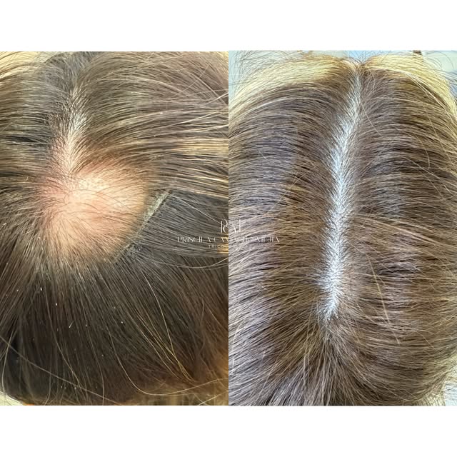 📍Antes e Depois que mostram mais do que fios. Passe para o lado e confira!

Na Alopecia Areata, o i