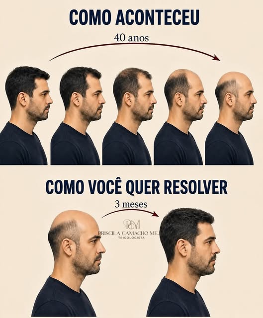 🚨Você deixou a calvície evoluir por anos, mas quando começa o tratamento, quer resultado em semanas