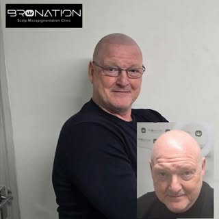 Bronation Scalp Micropigmentation Clinic. 
The ONLY 100% guaranteed solution for hair loss.

Doing w