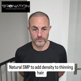 #scalpmicropigmentation #smpmanchester #bald #smp #hairtattoo