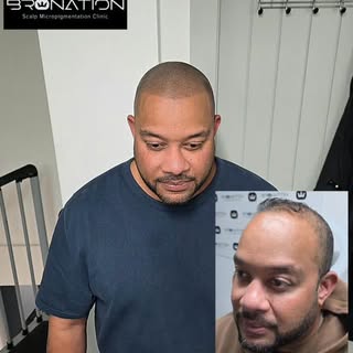 How much cleaner and sharper does a fresh hairline look compared to thinning hair? 👌

Scalp Micropi