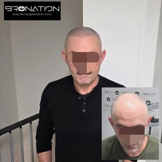 Say goodbye to hair loss at Manchester based Bronation Scalp Micropigmentation Clinic. 

100's of ve