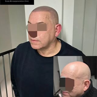 #scalpmicropigmentation #smp #smpmanchester #hairtattoo #hairlosssolution