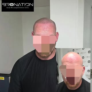 A hairline makes all the difference to your appearance and confidence. 
Get a fresh new look for sum