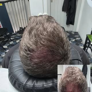 Thinning crown? 

Session 1 of 3 and clear results already visible. The crown will look full density