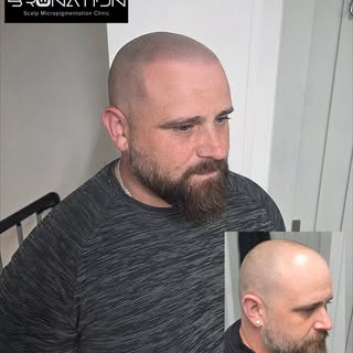 🇬🇧Manchesters No.1 natural look SMP specialist.🇬🇧

Baldness, thinning hairline, scars, alopecia?