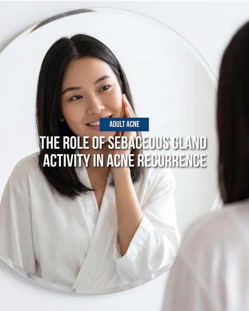 Recurring acne is often not just a bacterial problem.

Overactive sebaceous glands can produce exces
