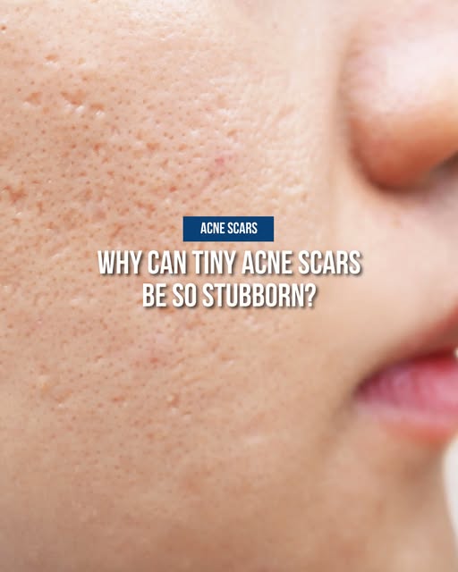 Ice pick scars may look tiny on the surface, but their narrow opening can extend much deeper into th