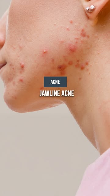 Breakouts along your jawline that keep coming back? Watch as Dr Bernard explains what could be contr