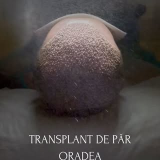 De ce merită să faci transplant de păr la Clinica Welbeck Life Oradea:
👨🏻‍⚕️ Profesionalism - Echi