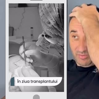 Diferență incredibilă la doar 4 luni și jumătate după implantul de păr ✨ Înscrie-te și tu acum pentr