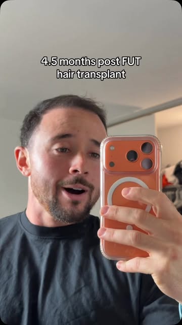Seeing some good progress thanks to @maneimagehair 

4.5 months post FUT hair transplant 😮‍💨

I st