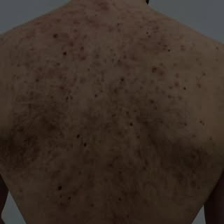 ✨ Back acne is more common than you think… and it can be treated.

It happens when pores on the back