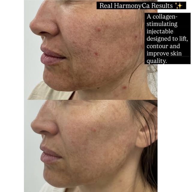 ✨ Real HarmonyCa Results ✨

Looking for a natural-looking way to improve facial definition, support 