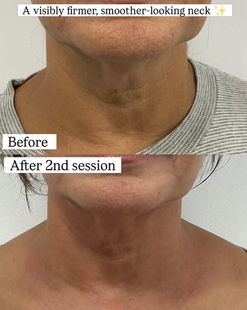 ✨ 2 SESSIONS OF RF — NECK TRANSFORMATION ✨

The neck is often one of the first areas where we start 
